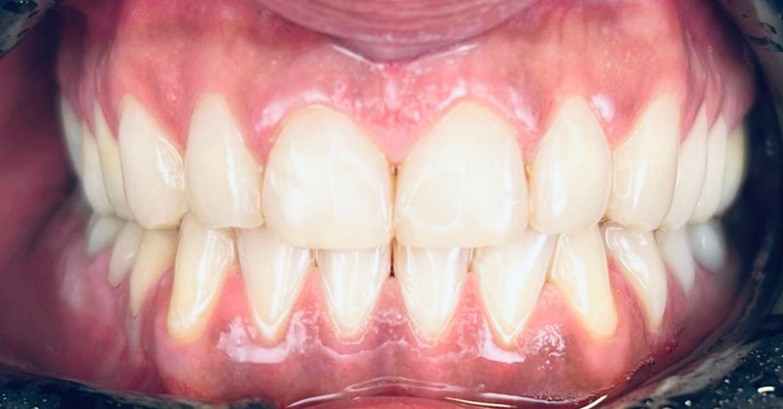 Kompozitne luske – po